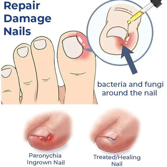 Anti Paronychia Relief Oil (Buy 1 Get 1 FREE) 🥳